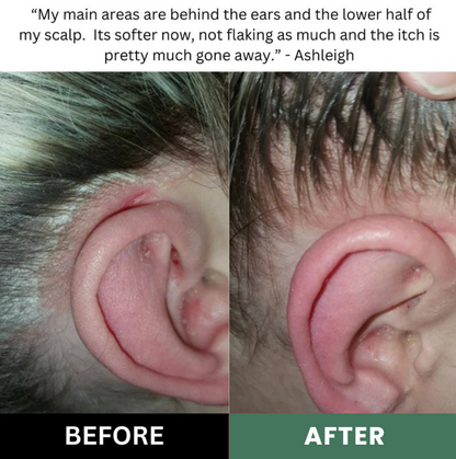 LISSIMA Natural Scalp Scrub – for Flaky, Itchy, Irritated Scalp (Sensitive Care)